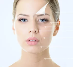 visage de femme montrant les differentes zones pour appliquer le soin acide hyaluronique 